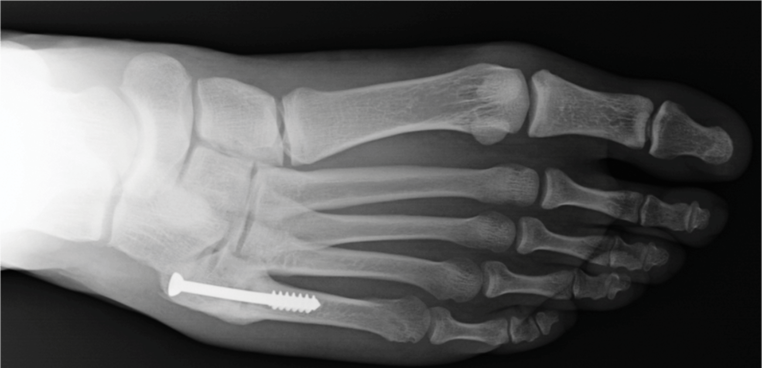 Radiografía del dedo del pie roto