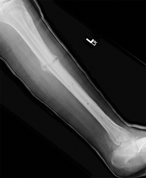 Radiografía de tibia rota