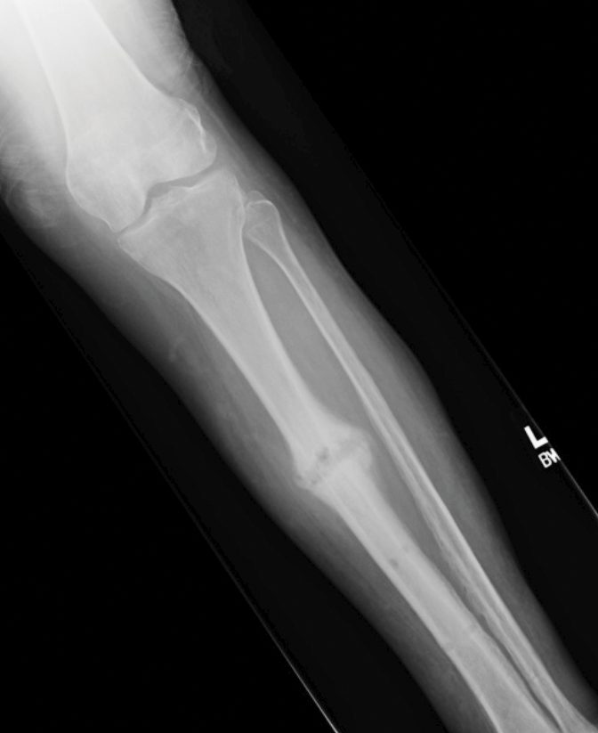 Radiografía 5 meses después