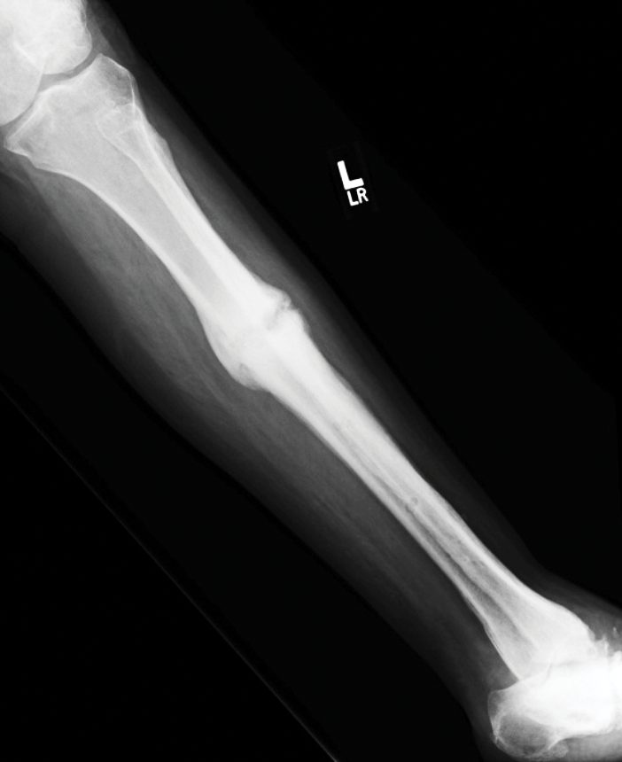 Tibia rota 7 meses después