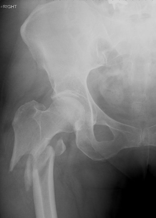 Radiografía de fémur roto