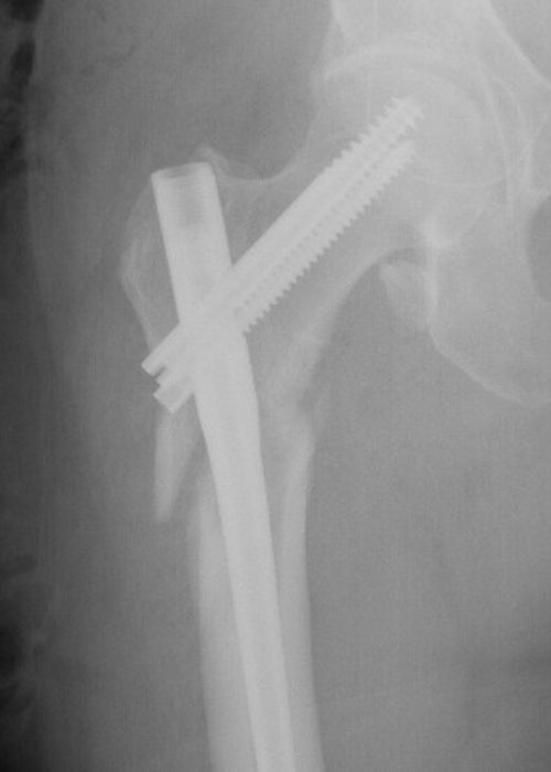 Radiografía del postoperatorio