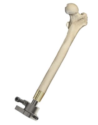 Gráfico del fémur con osteointegración