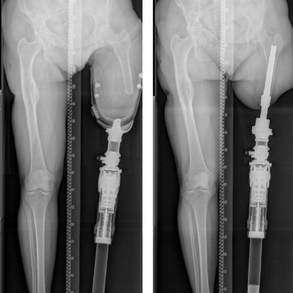 Excelente resultado del tercer caso del Grupo Australiano de Osteointegración en España