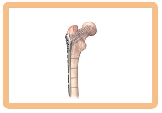 PFP Femur Periloc