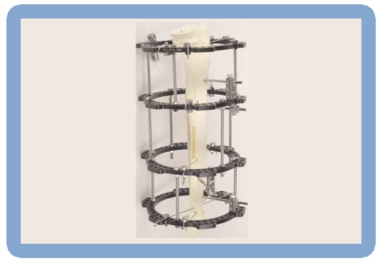 Ilizarov external fixator