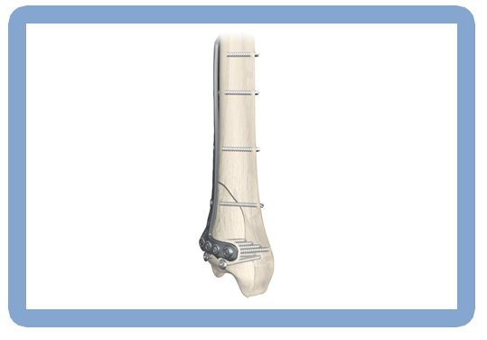 Periloc Proximal Tibial Plate