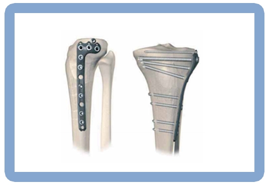 Tibia Periloc Plate