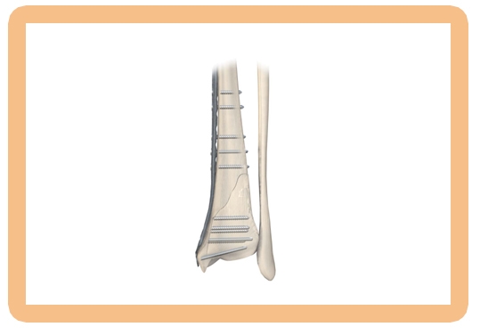Medial Distal Tibia Periloc