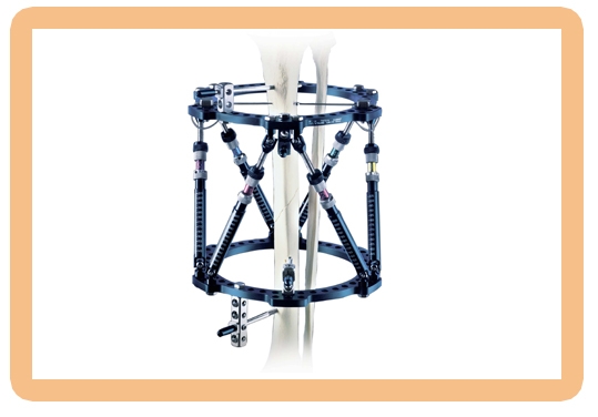 Taylor Spatial Frame external fixator