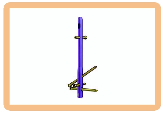 Trigen Hindfoot Nail