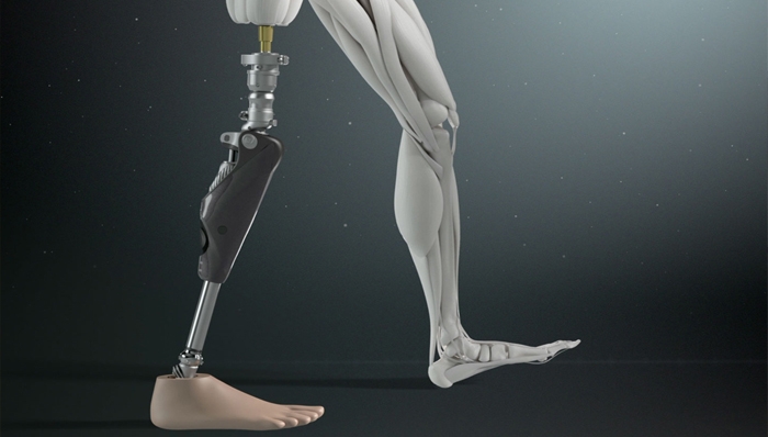 Capacidad  de Deambulación y Calidad de Vida en Sujetos Con Amputación  Transfemoral: Una Comparación entre Osteointegración y Prótesis de  Encaje