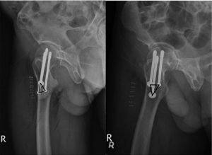 Factores  de Riesgo de Pseudoartrosis en Pacientes con Fracturas de Cuello  Femoral Intracapsulares con Tres Tornillos Canulados Posicionados en  Configuración Triangular o Triangular Invertida.