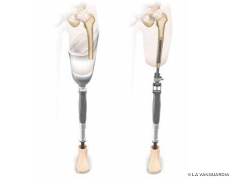 Dibujo de diferencias entre prótesis y osteointegración