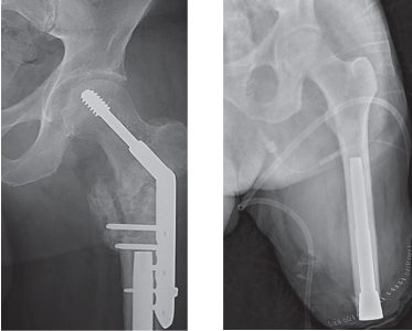 Las fracturas periprotésicas asociadas a osteointegración son infrecuentes y de manejo familiar.
